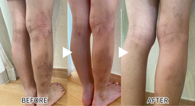 皮膚トラブルのBefore after